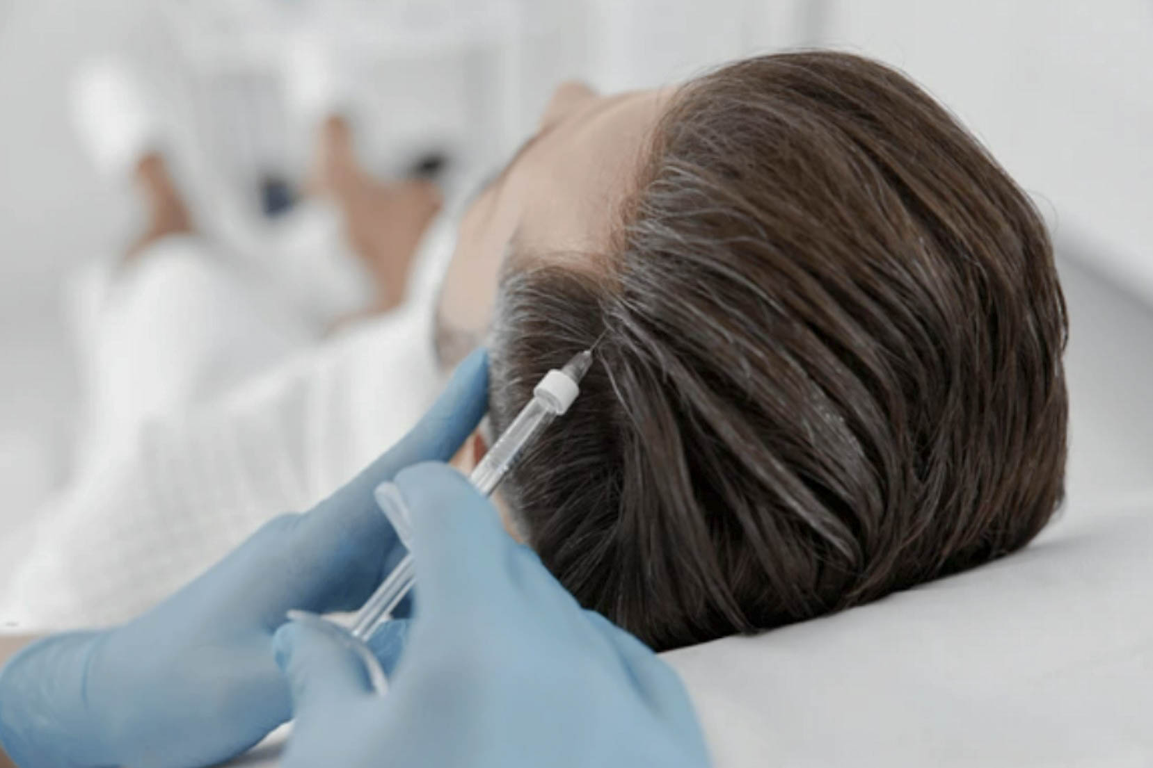 Mesoterapia para Caída del Cabello