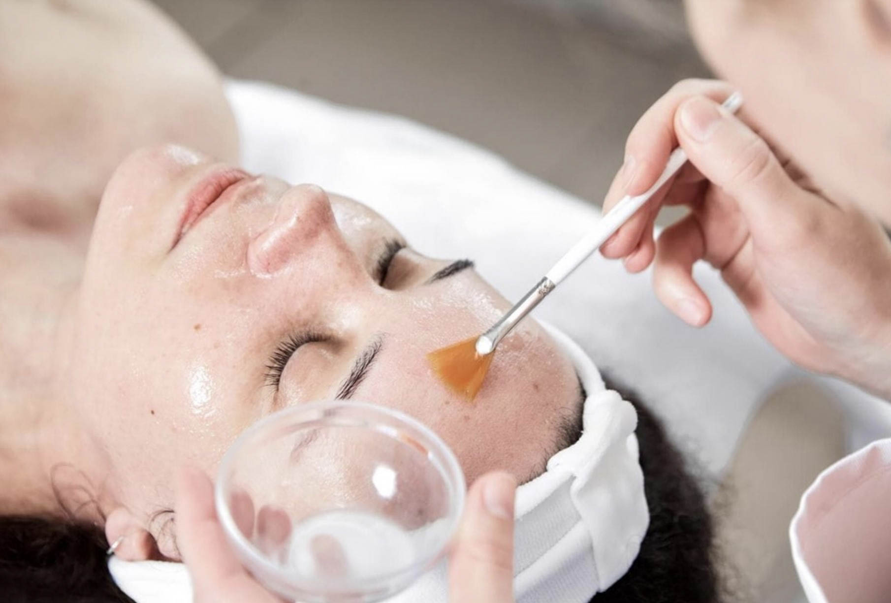 Peeling (exfoliación) química