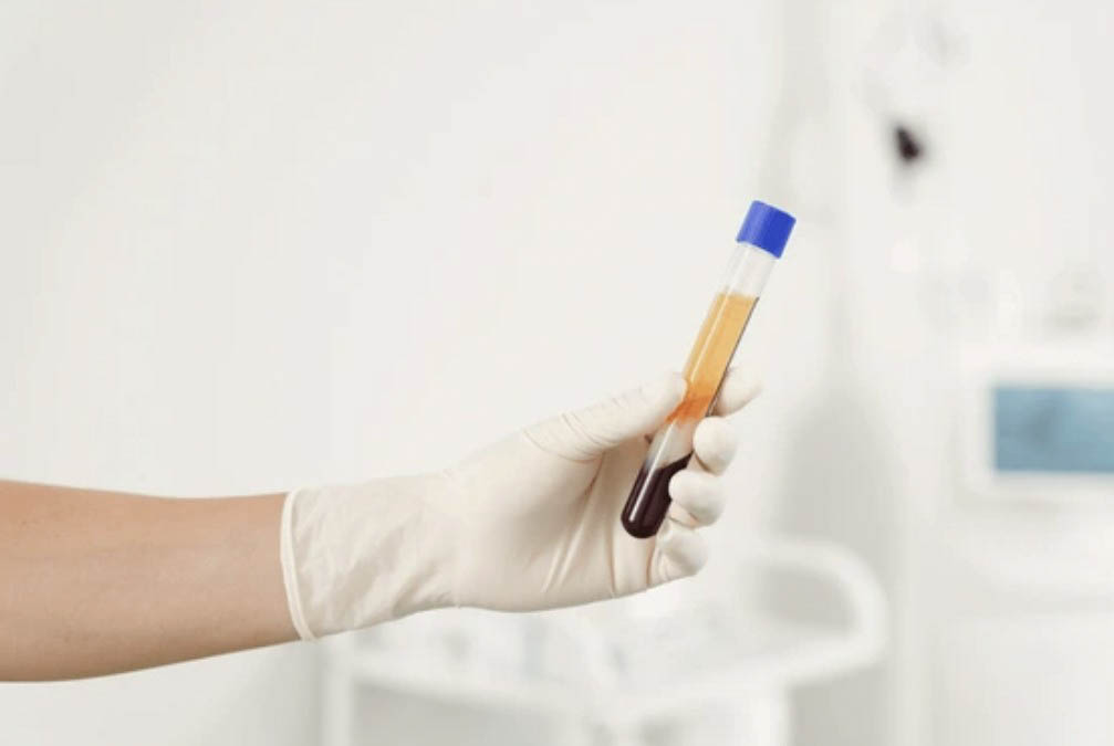 Plasma Rico en Plaquetas: Alopecia y Piel